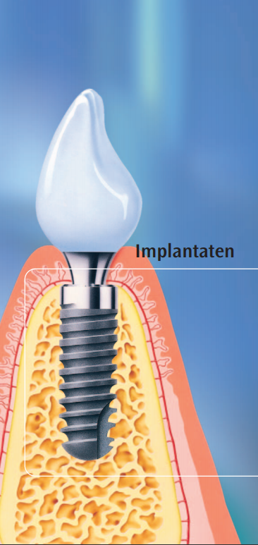 Implantaten