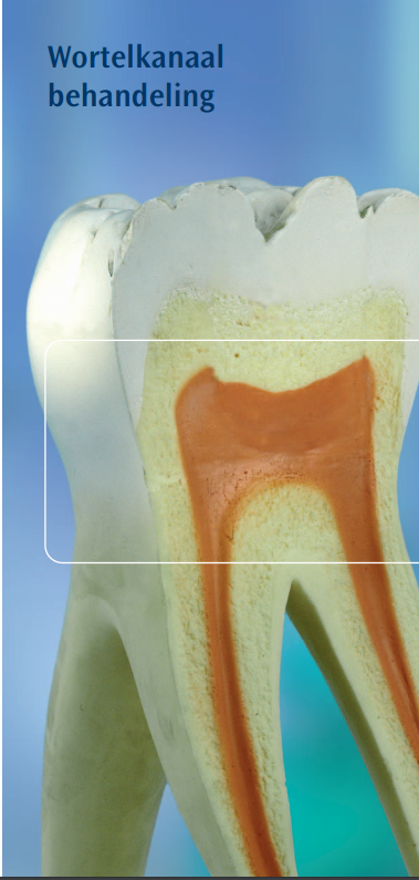 Wortelkanaalbehandeling